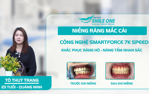 Khách hàng Thuỳ Trang: Chỉnh hô, sửa lệch tự tin rạng rỡ sau tháo niềng tại Smile One